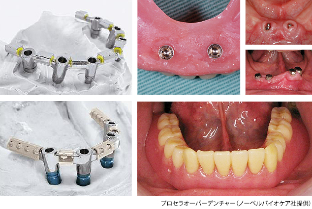 インプラントオーバーデンチャー/ロケーター義歯